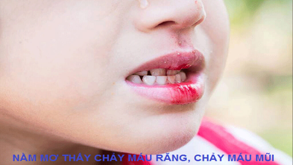 Nằm mơ gãy răng chảy máu là điềm gì?