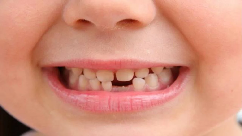 Nằm mơ thấy gãy răng chảy máu