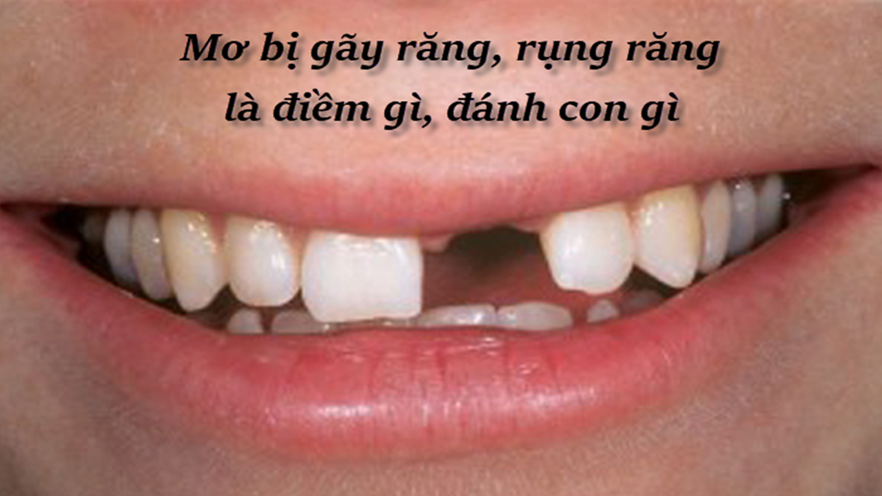 Thấy gãy răng cửa đánh số mấy